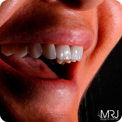 image-sorriso-oque-sao-facetas-reduz